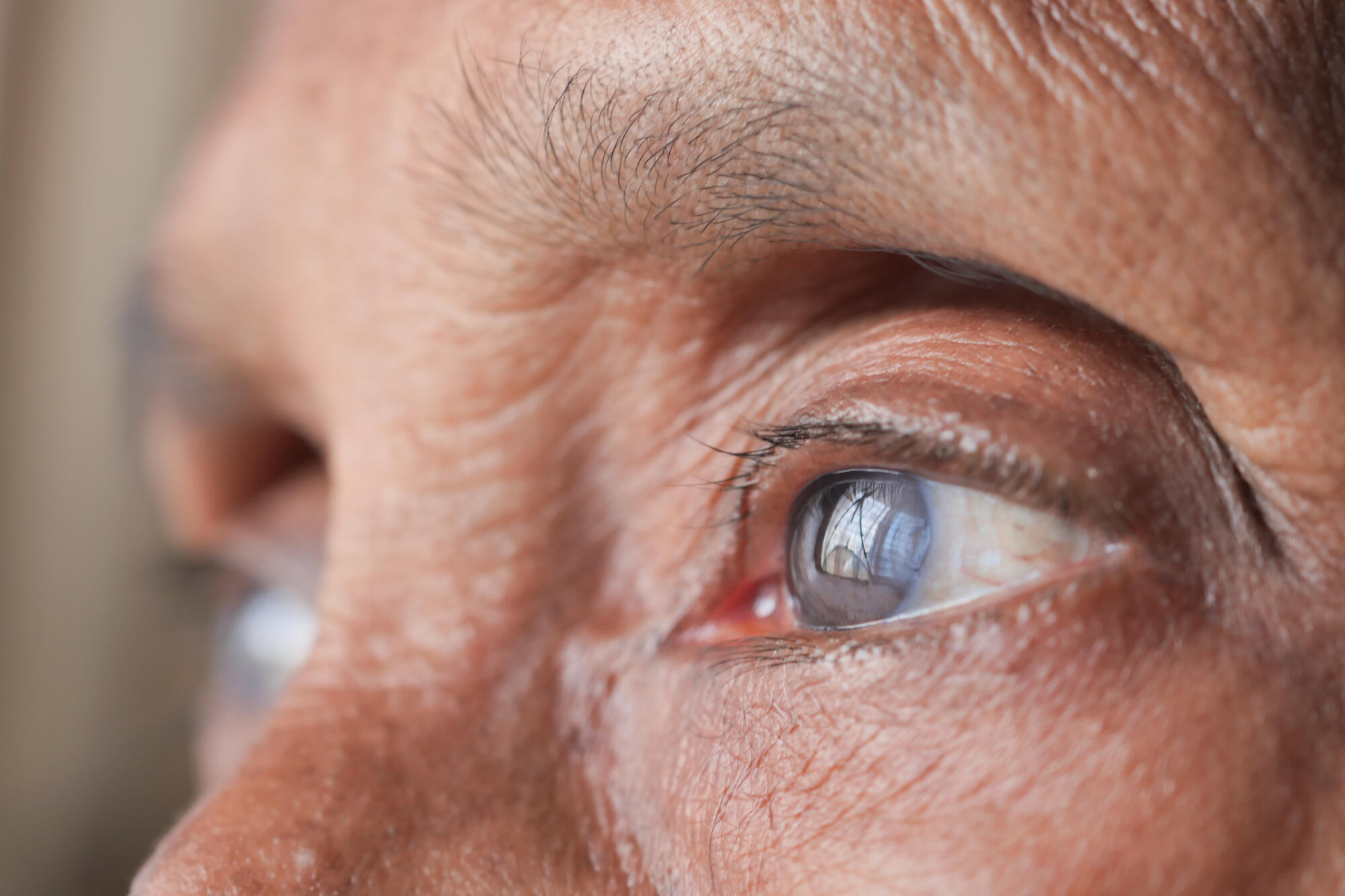 Can Cataracts Come Back After Surgery? What Seniors Should Know